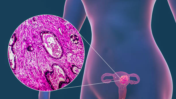 POPMEDICINE | Рак эндометрия (тела матки): симптомы, диагностика и лечение