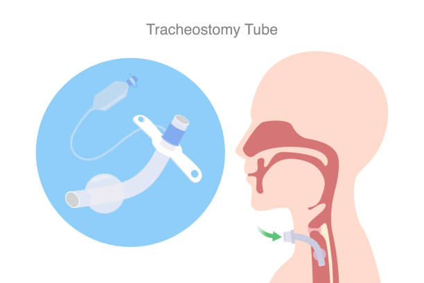 POPMEDICINE | Наложение трахеостомы: Показания, процесс и уход после операции